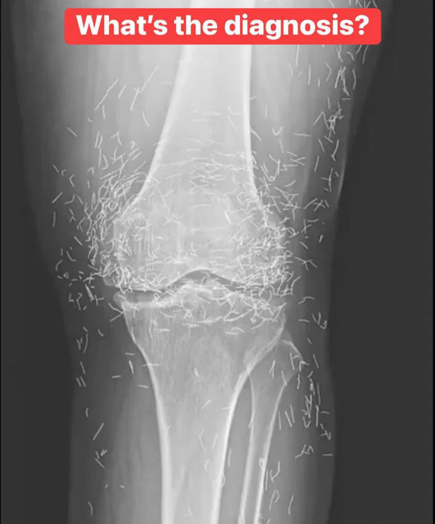X-Ray Reveals Hundreds of Gold Needles in Woman’s Knees